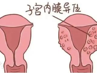 50%的痛经是因为它！50%的不孕还是因为它！