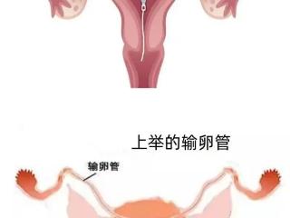 输卵管上举影响怀孕吗？跳绳能好吗？姐妹们看过来！