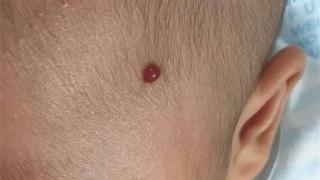 新生儿面部血管瘤图片