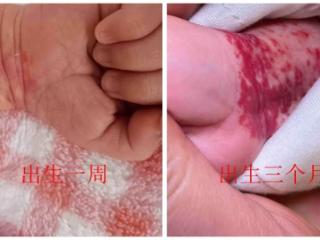 成都川蜀血管病医院专家教你一招：身上的“小红点”是不是血管瘤，一看便知!