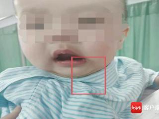 海南一7月龄宝宝吞了根头发，竟在喉咙打个结 医生：确实罕见