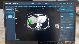 滨州医学院附属医院引进国际首创多模态肿瘤治疗技术，抗癌又添“新利器”