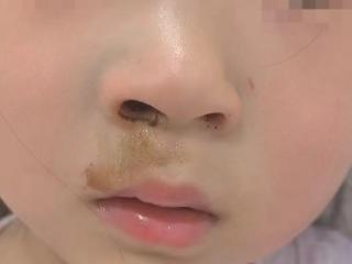 警惕！3岁女童将纽扣电池放入鼻腔……专家：幸好及时发现，严重可致鼻穿孔