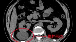 肾囊肿导致腰痛 宁阳县第一人民医院腹腔镜为其微创“去顶减压”