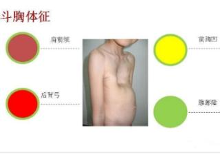 小叶医探 | 阜阳一名儿童胸部凹陷能放一碗水，被确诊为漏斗胸