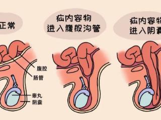 怎么诊断小儿疝气？腹股沟包块都是疝气吗？