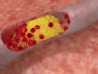 别把胆固醇高不当回事！两项研究同时指出：血脂失控，后患无穷