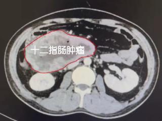 国庆我在岗⑤｜旅行途中“弃车”折返救援 肝胆外科8小时手术救回孩子父亲