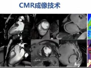 济南市五院医学影像科开展心脏磁共振检查填补医院技术空白