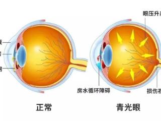 专家谈眼病|青光眼的早期症状