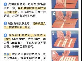 瘢痕不再烦恼！专家科普减张器的使用与注意事项