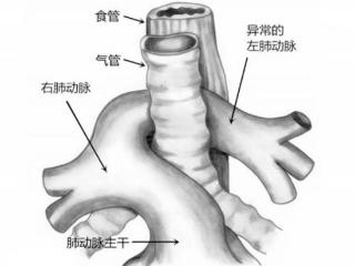 小叶医探 | 为新生儿“再造”气管，安徽首例婴幼儿气管成形手术顺利完成