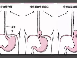 临沂市中医医院：腹腔镜下修补食管裂孔疝