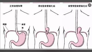 临沂市中医医院：腹腔镜下修补食管裂孔疝