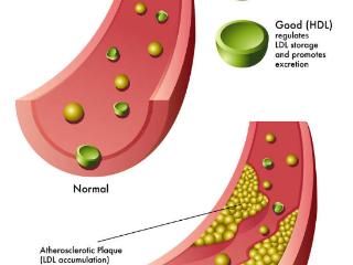 上海瑞金研究：胆固醇越低，癌症风险越高？学会3招控制血脂