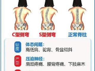 脊柱“大梁”不可歪！青少年特发性脊柱侧弯防治需重视