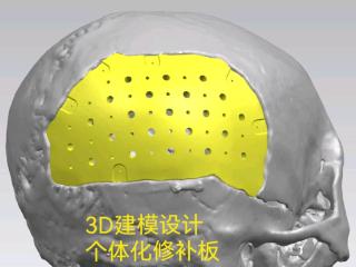 夏小雨医生团队成功运用3D打印PEEK材料：助力颅骨修补精准化