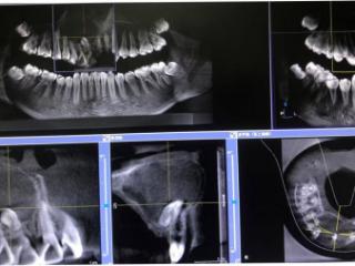 多生牙千奇百怪：青岛妇儿医院口腔颌面外科接诊多样病例