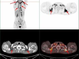 “核”你一起揭秘PET/CT显像中的假象—棕色脂肪显影