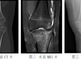 山东大学齐鲁医院（青岛）完成关节镜下手术