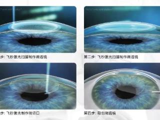 四川做飞秒最好的医院，全飞秒VS半飞秒 近视手术怎么选？