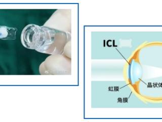 东莞光明眼科医院：飞秒和晶体植入，哪种近视手术更好？