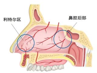 鼻出血多发，该如何正确止鼻血？