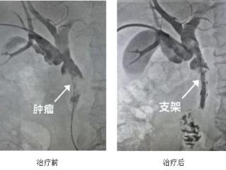 省内首例！山东大学齐鲁医院普通外科胆道肿瘤治疗团队实施放射性粒子胆道支架置入术治疗胆管癌