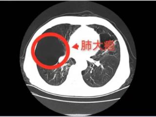 成都中医哮喘医院：妙手上演肺大疱消失术 帮助肺大泡患者实现呼吸自由