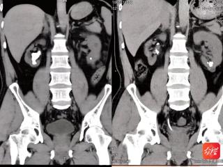 肾结石形同“鹿角”！沿河人民医院钬激光碎石解患者多年困扰