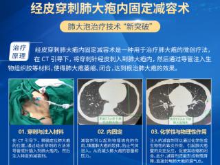 成都中医哮喘医院：经皮穿刺肺大疱内固定减容术，帮助肺大泡患者呼吸重生