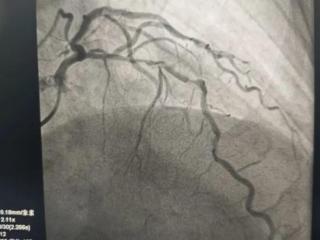 日照心脏病医院常规开展复杂冠脉病变治疗手术