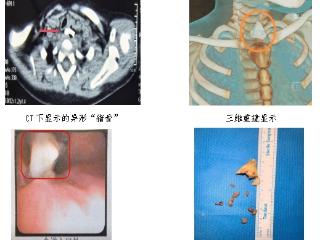 济南市儿童医院：“大口吃肉”有风险，“祸从口入”惹麻烦