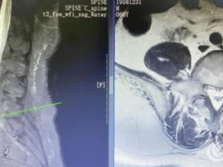 巨野县中医医院骨一科：攻克罕见病难题，成功救治椎管内脂肪增多症患者