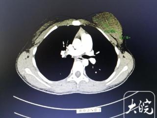 小叶医探｜13岁女孩乳房一大一小，确诊乳腺肿瘤！