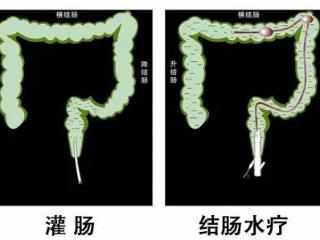 奇山医院科普：一文读懂结肠水疗和灌肠的区别