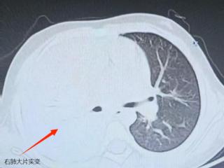 抗生素治疗陷僵局，男孩右肺成了“蜂窝煤”！治疗“利器”是它……