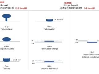 这些位置长了息肉一定要当心：有种几乎100%会癌变！