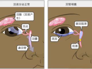 济南眼科医院健康科普｜疏通眼泪通道，还你干爽眼眸