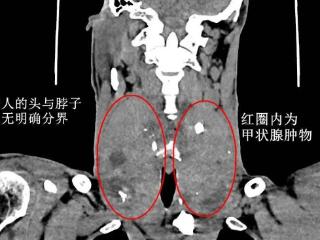 六旬老人颈挂“双球”，日照市中医医院乳甲外科紧急“排雷”