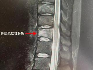 每天4杯咖啡 25岁女孩确诊骨质疏松 弯个腰骨折了