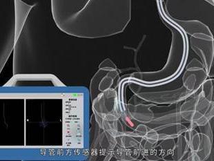 山东省耳鼻喉医院成功开展首例磁导航下的床旁鼻肠管置入术