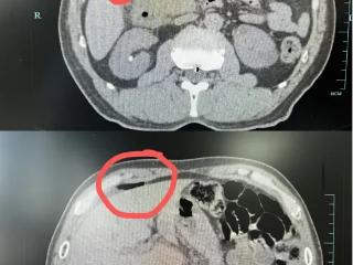 一碗下肚，杭州男子痛得紧急入院！正大量上市……