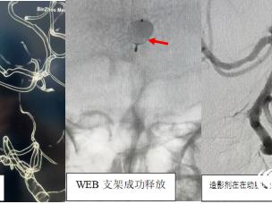 滨医烟台附院神经介入科置入首例WEB