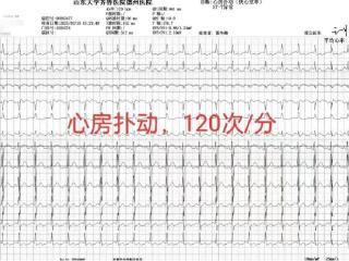 齐鲁医院德州医院成功完成高难度射频消融术，电生理水平再上新高