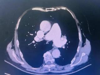 突破性医疗技术，济南市五院成功救治82岁急性肺动脉栓塞患者