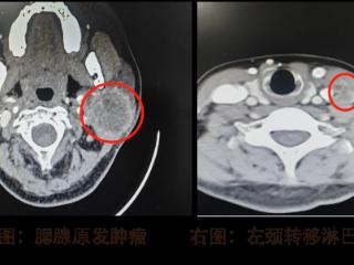 女子耳垂下方长“小疙瘩”10年没重视 没想到竟是腮腺癌