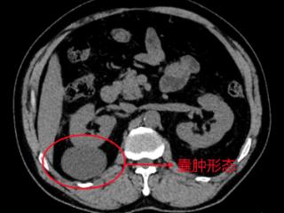 宁阳县第一人民医院微创手术解除肾脏“定时炸弹”