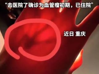 一张照片竟被网友看出血管瘤 身体出现这3个信号要当心
