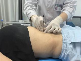 泰安市第一人民医院穴位埋线：一种独特的中医疗法
